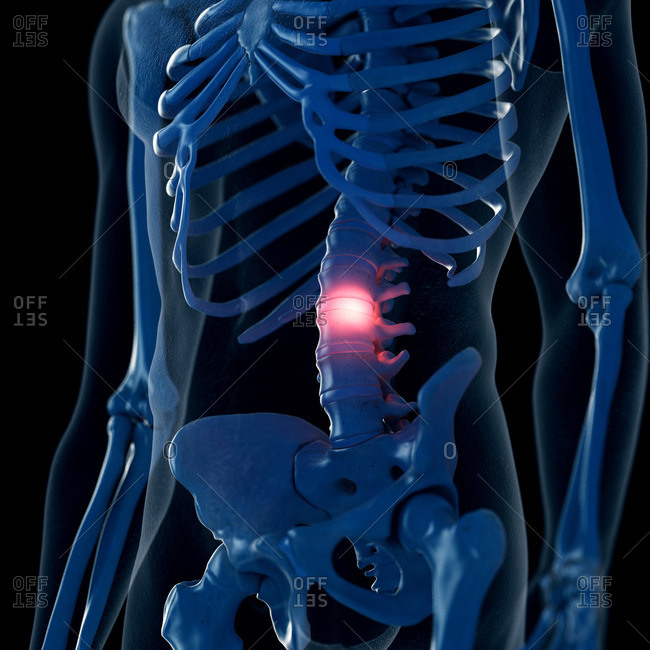 Illustration of a painful lumbar spine.