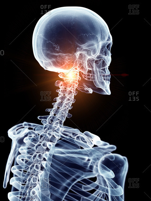 Illustration of a painful cervical spine.