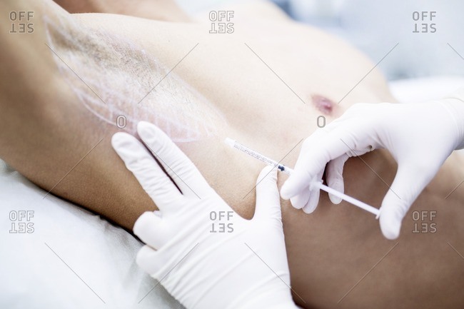 Dermatologist injecting botox into the underarm to treat excessive sweating, close-up.