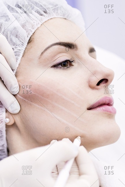 Dermatologist drawing marks on woman face for thread-lift, close-up.