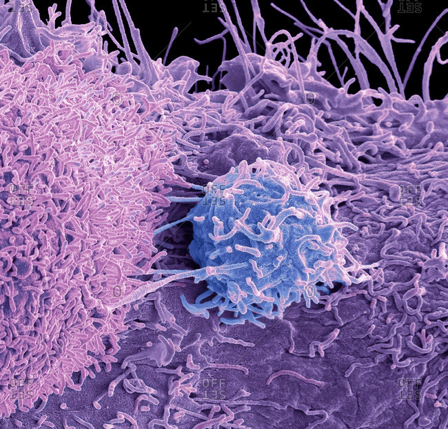 Prostate cancer cell, colored scanning electron micrograph (SEM). of the surface of prostate cancer cells. The cells shows numerous processes and microvilli (fine surface projections). These features are characteristic of highly mobile cells, and enable cancerous cells to spread (metastasis) rapidly round the body, and invade other organs and tissues. Cancer cells divide rapidly and chaotically, and may clump to form malignant tumors. The prostate is a small gland found in men just below the bladder, surrounding the urethra, the tube urine passes through. Prostate cancer is most prevalent in men over 50 years of age. Treatment is with hormone therapy, chemotherapy, or surgical removal of the prostate. Magnification: x 8000 when printed at 10 centimeters across.