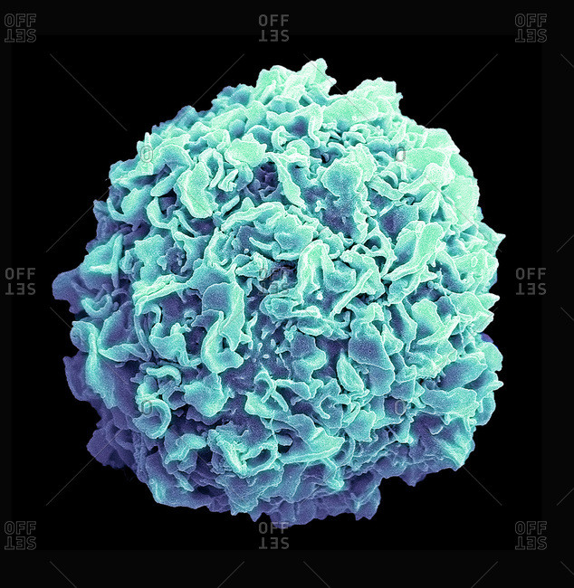 Breast cancer cell. Colored scanning electron micrograph (SEM) of a breast cancer cell. The cell shows numerous processes and micro plicae (fine surface folds). These features are characteristic of highly mobile cells, and enable cancerous cells to spread (metastasis) rapidly round the body, and invade other organs and tissues. Cancer cells divide rapidly and chaotically, and may clump to form malignant tumors. The tumors often invade and destroy surrounding tissues. Breast cancer is the most common form of cancer in women. Treatment involves surgical removal of the tumor, often combined with radiotherapy and chemotherapy. Magnification: x3500 when printed 10cm wide.