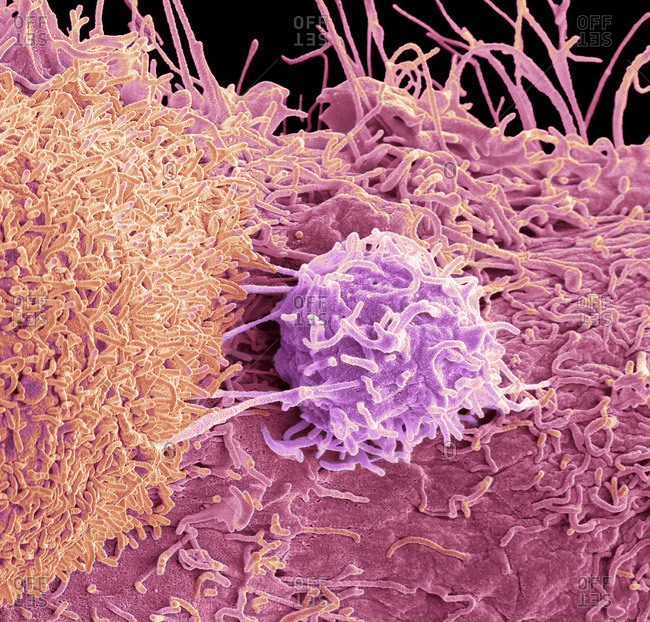 Prostate cancer cell, colored scanning electron micrograph (SEM). of the surface of prostate cancer cells. The cells shows numerous processes and microvilli (fine surface projections). These features are characteristic of highly mobile cells, and enable cancerous cells to spread (metastasis) rapidly round the body, and invade other organs and tissues. Cancer cells divide rapidly and chaotically, and may clump to form malignant tumors. The prostate is a small gland found in men just below the bladder, surrounding the urethra, the tube urine passes through. Prostate cancer is most prevalent in men over 50 years of age. Treatment is with hormone therapy, chemotherapy, or surgical removal of the prostate. Magnification: x 8000 when printed at 10 centimeters across.