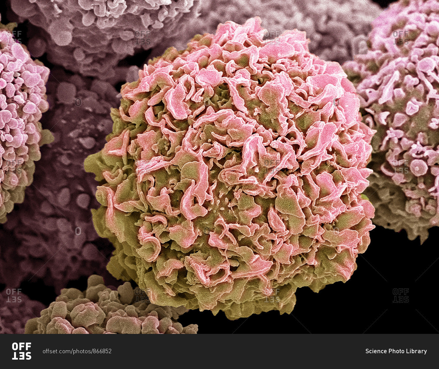 Breast cancer cells. Colored scanning electron micrograph (SEM) of breast cancer cells. The cells shows numerous processes and micro plicae (fine surface folds). These features are characteristic of highly mobile cells, and enable cancerous cells to sprea