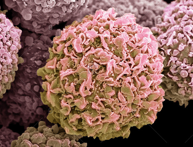 Breast cancer cells. Colored scanning electron micrograph (SEM) of breast cancer cells. The cells shows numerous processes and micro plicae (fine surface folds). These features are characteristic of highly mobile cells, and enable cancerous cells to spread (metastasis) rapidly round the body, and invade other organs and tissues. Cancer cells divide rapidly and chaotically, and may clump to form malignant tumors. The tumors often invade and destroy surrounding tissues. Breast cancer is the most common form of cancer in women. Treatment involves surgical removal of the tumor, often combined with radiotherapy and chemotherapy. Magnification: x3500 when printed 10cm wide.
