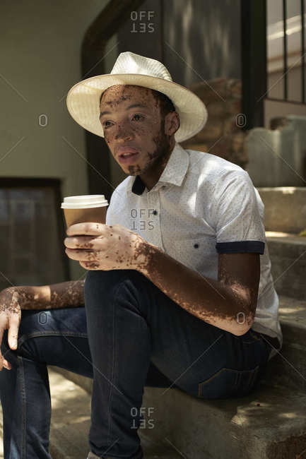 Young man with vitiligo having a cup of coffee in a cafeteria