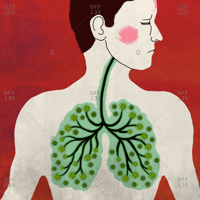 Illustration of lungs of a corona infected patient