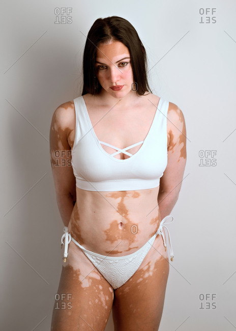 Young woman, with vitiligo disease, posing in the studio in a who