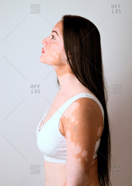 Side portrait of a young woman, a real vitiligo patient, posing