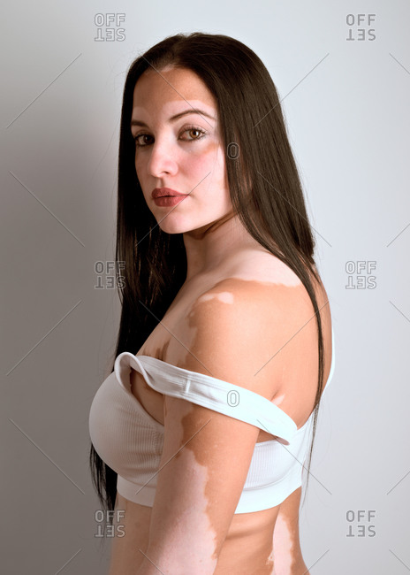 Profile portrait of a young woman, a real vitiligo patient, pois