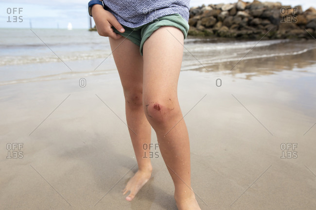 Child standing in ocean tide showing his injured knee
