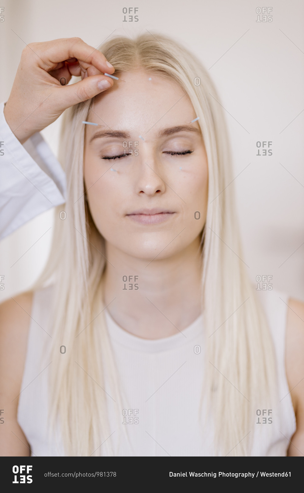 Acupuncture- young woman with acupuncture needle during treatment in the face