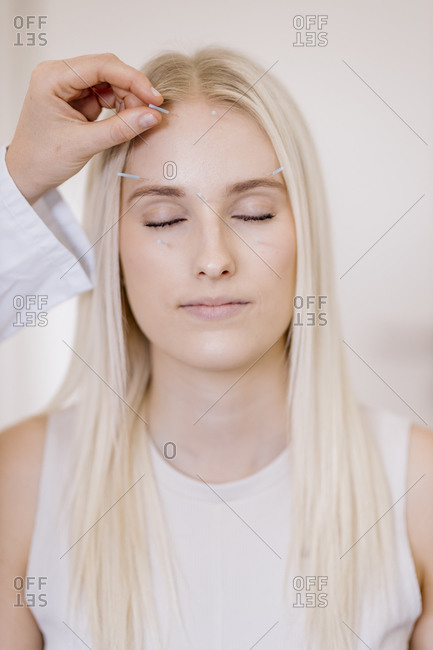 Acupuncture- young woman with acupuncture needle during treatment in the face