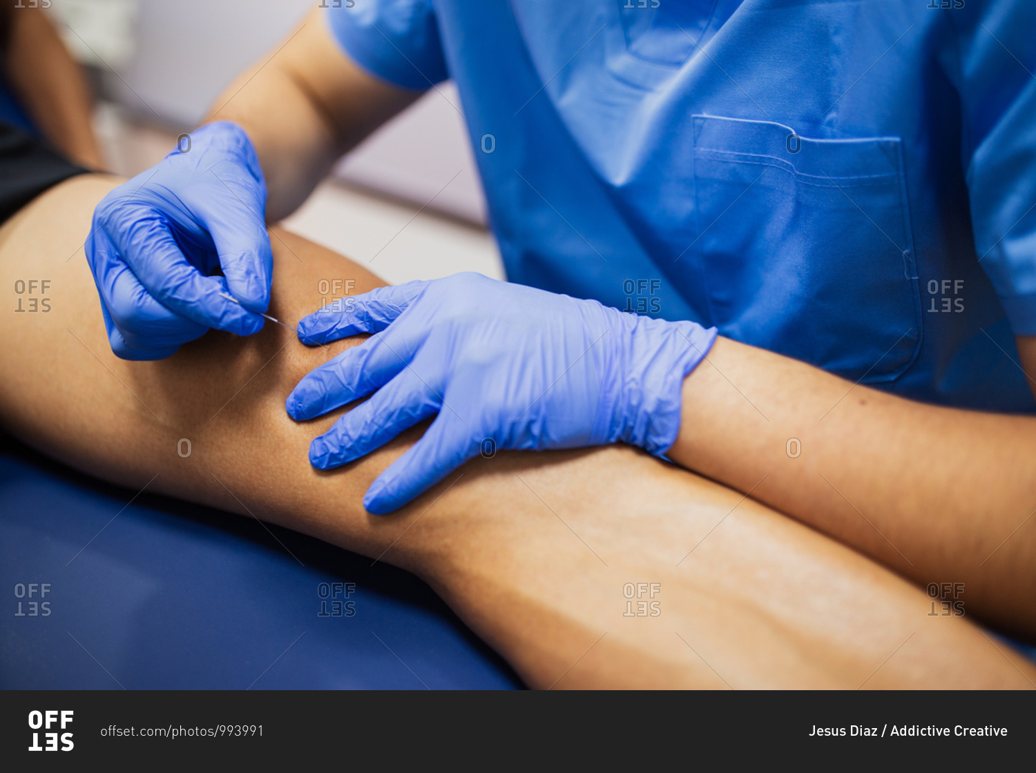 From above of crop faceless sports medicine doctor in sterile gloves inserting thin needle in leg of unrecognizable male patient in underwear lying on examination couch during acupuncture process