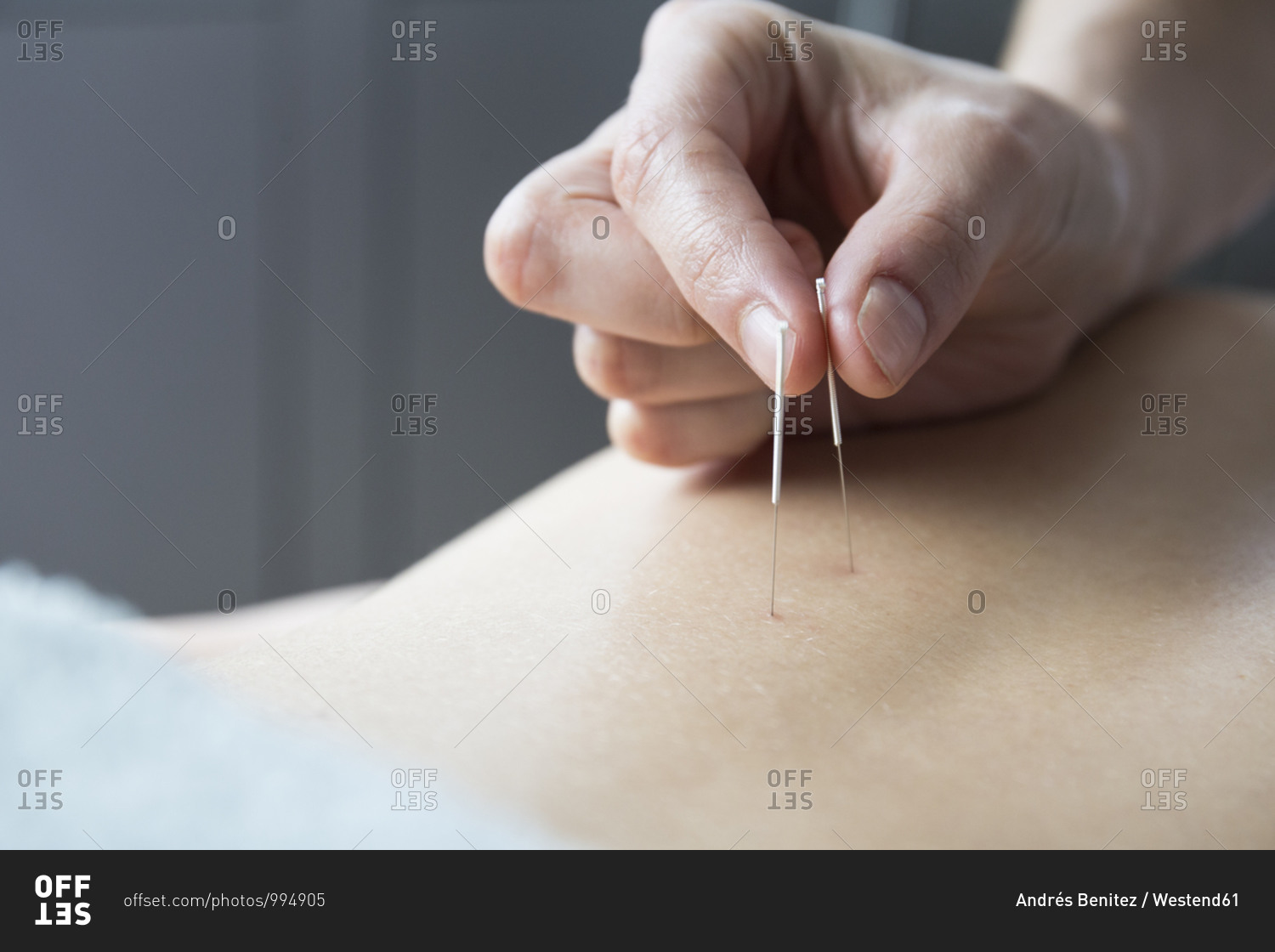 Close up acupuncturist applying acupuncture needles to woman\'s back