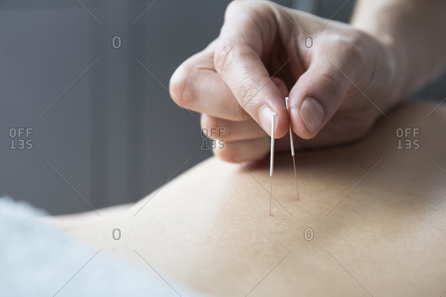 Close up acupuncturist applying acupuncture needles to woman\'s back