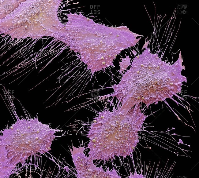 Bone cancer cells. Colored scanning electron micrograph of osteosarcoma cancer cells.