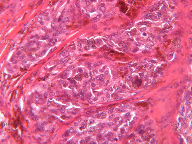 Microscope view of malignant melanoma