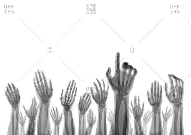 X-ray of hands reaching up