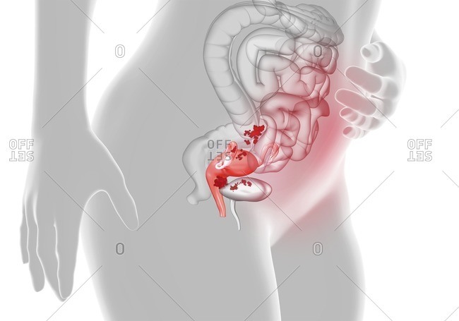 Computer illustration showing a female reproductive system where the endometrium is extending outside the uterus into the fallopian tube, ovary and abdominal cavity, in a disease called endometriosis