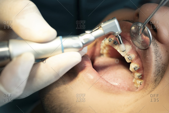 Hand of orthodontist using dental drill on male patient wearing braces