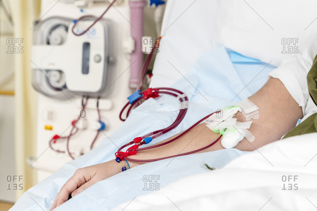 Arm of a patient with a hemodialysis catheter during a treatment