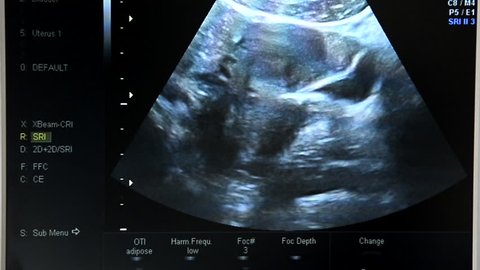 Baby Boy Ultrasound Of 16 Video De Stock 100 Libre De Droit Shutterstock Baby Boy Ultrasound Of 16 Video De Stock 100 Libre De Droit Shutterstock
