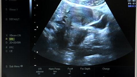 Baby Boy Ultrasound Of 16 Video De Stock 100 Libre De Droit Shutterstock