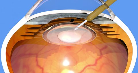 Cataract surgery. Intraocular lens implanted inside the eye. 3d render. 4K.