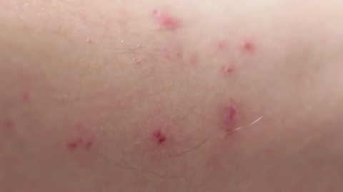 pimples or mosquito bites on a person's skin. Close-up