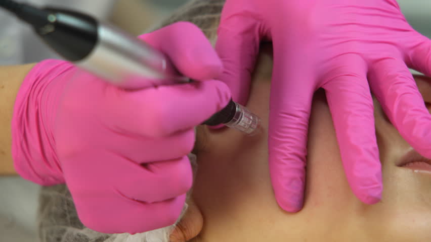 Close-up of a beauty salon specialist performing the micro-needling mesotherapy treatment with a derma-pen machine. | Shutterstock HD Video #1006770844