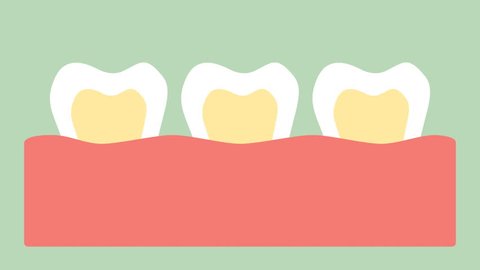 stages of tooth decay or dental caries - teeth cartoon vector flat style render 2d footage animation, in 4K and UHD ultra high definition video format 3840x2160