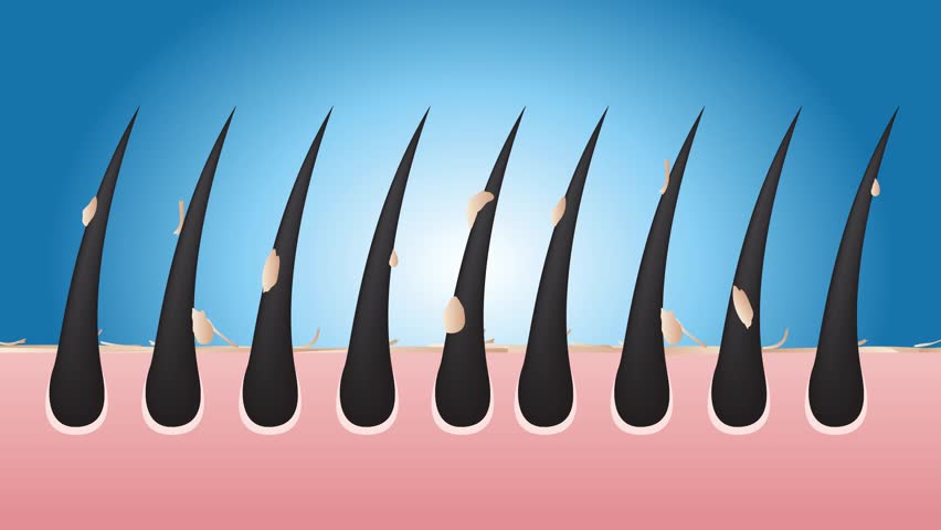 Anti Dandruff stages vector , closeup on skin and dandruff ( black hair )