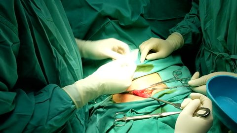 4K footage of a surgeon trimming the synthetic mesh for Inguinal hernia repair operation.
