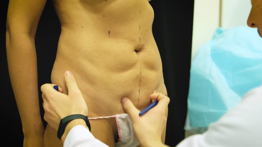 The surgeon draws the markup before the operation by liposuction on the patient to the woman.
