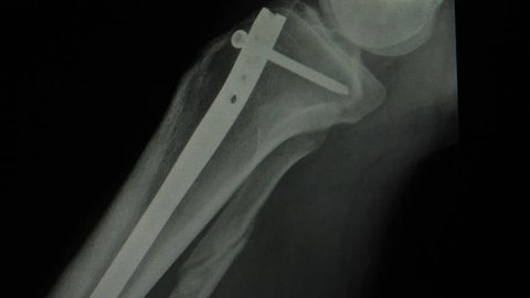 Titanium rod and screw internal fixation in broken leg close up