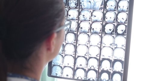 Doctor looks at brain MRI scan