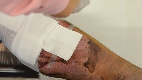 Dressing Deep partial-thickness burns wound.