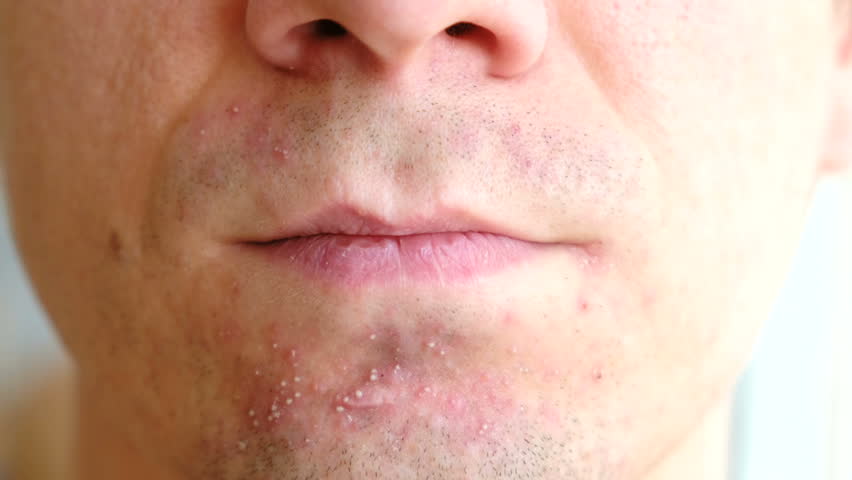 skin-irritation-after-shaving-pimples-stock-footage-video-100