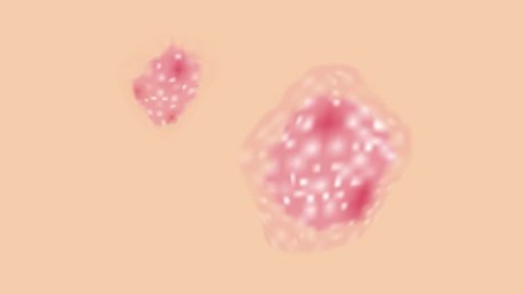 skin disease graphic animation / psoriasis , urticaria , eczema