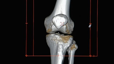 CT Knee or CT Scan image of left knee  3d rendering image rotating on monitor.