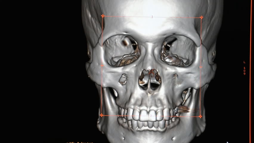 Ct Scan Of The Skull の動画素材 ロイヤリティフリー Shutterstock