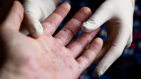 Doctor in gloves examines the hands of a man with psoriasis.