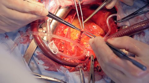 Heart vein is being examined by a team of doctors in an operation process