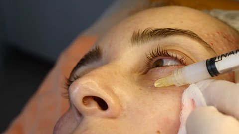 Cosmetician in gloves making face lifting injection to area around eyes. female client gets facial beauty procedure in healthcare clinic. liquid thread injection. Botox. collagen