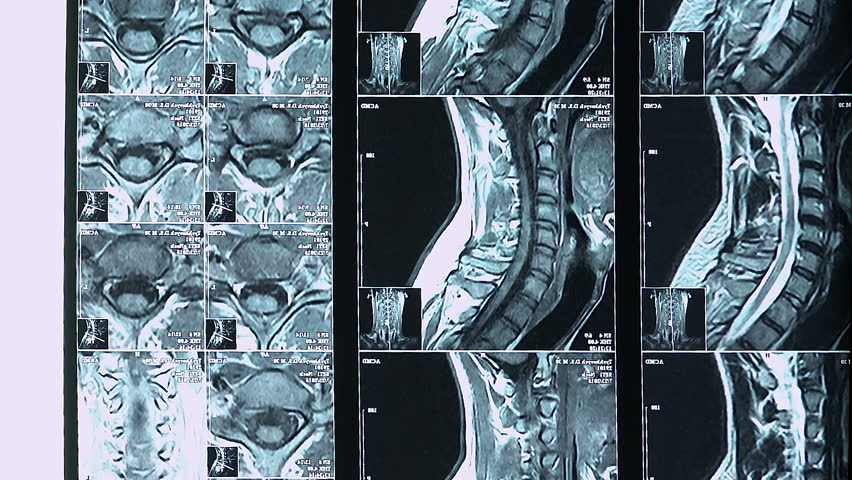 Где можно сделать мрт позвоночника. Мрт позвоночника целиком. Мрт позвоночника средней части. Мрт позвоночника доктор. Мрт позвоночника спортсмена.