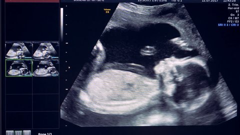 Embryo is actively moving an rolling over on an ultrasound image