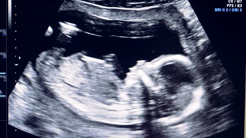 Human embryo is slightly moving his head on an ultrasound display