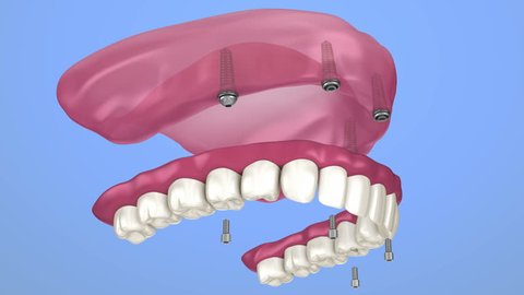 Overdenture to be seated on implants - ball attachments, instalation process. 3D animation 