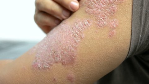 Hands of man scratching arm skin rash psoriasis